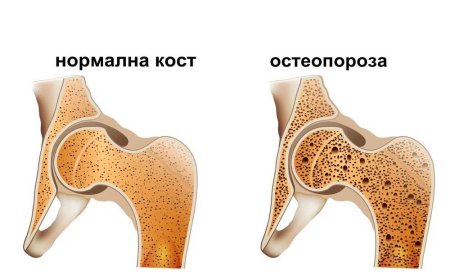 20 октомври е Световен ден за борба с остеопорозата