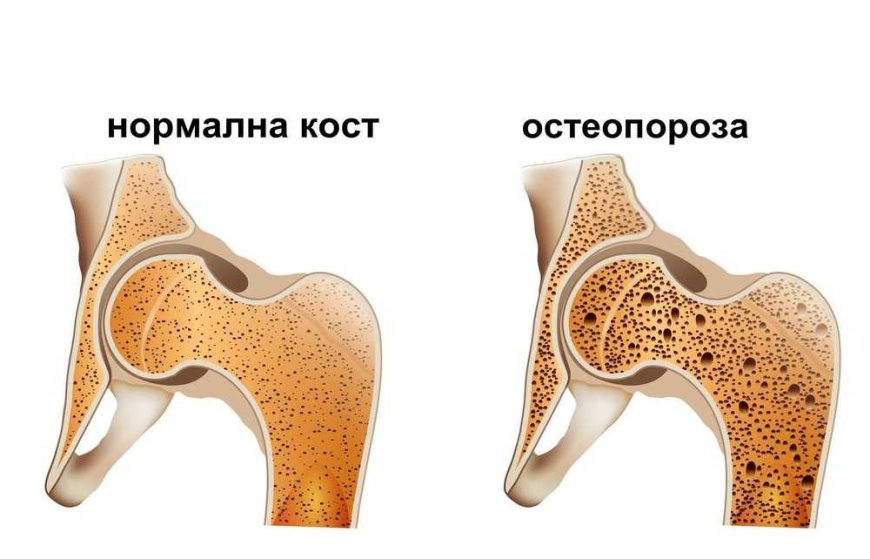 20 октомври е Световен ден за борба с остеопорозата