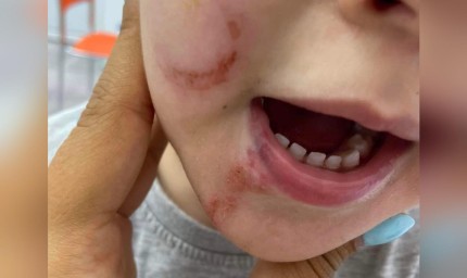 Наказание за детска градина в Добрич заради липса на комуникация с родител на наранено дете